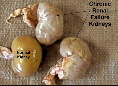 Chronic Renal Failure Kidneys